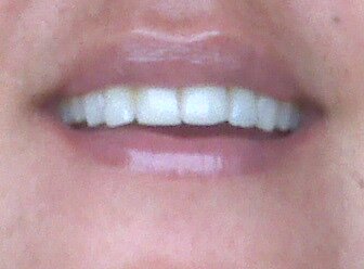 teeth bleaching