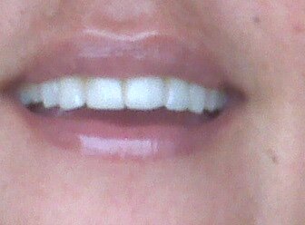 teeth bleaching